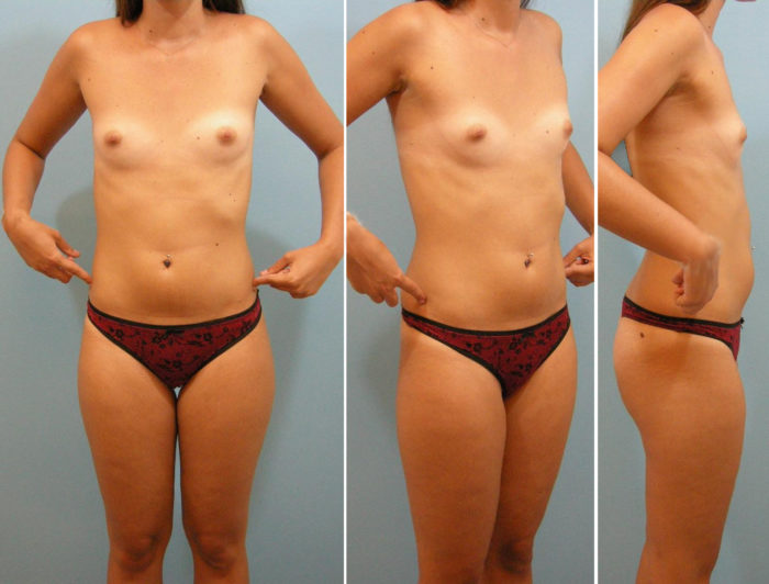 Brustvergrößerung und Liposuktion
