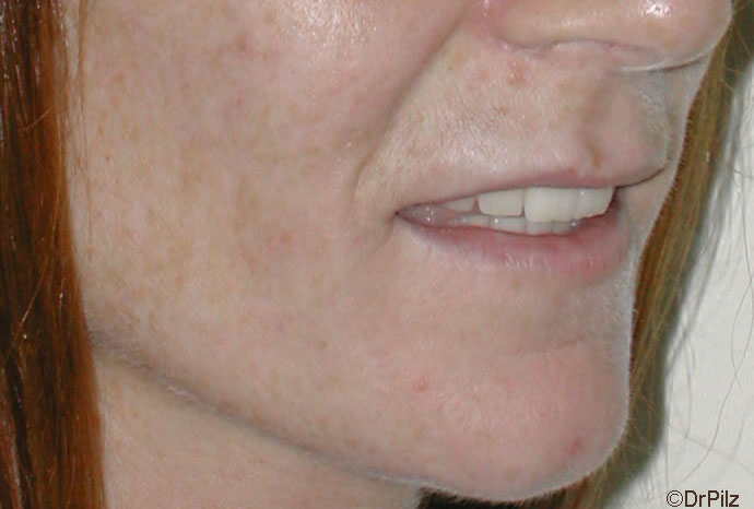 Lippen vor Vergrößerung mit Eigenfett