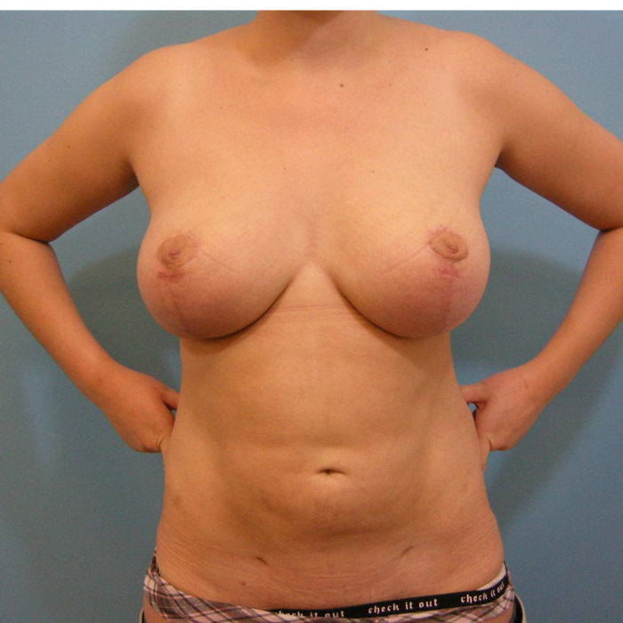 Brustverkleinerung vertikal und Liposuktion Bauch
