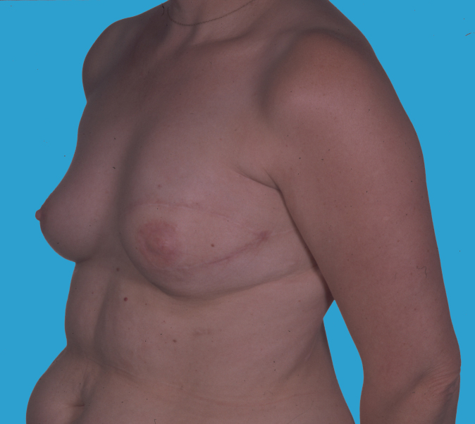 amputierte Brust links nach Brustrekonstruktion