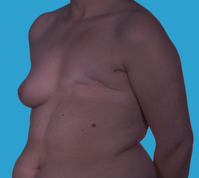 amputierte Brust links vor Brustrekonstruktion