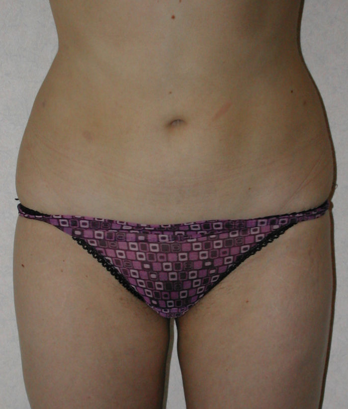 Liposculpture - Liposhaping