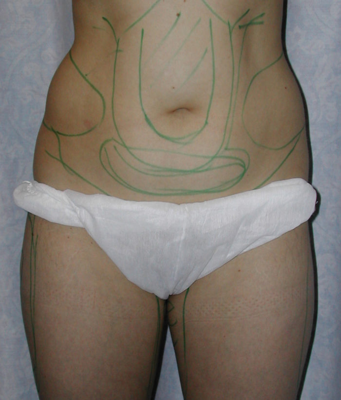 Liposculpture - Liposhaping