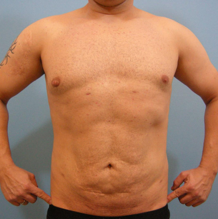 Liposhaping Sixpack