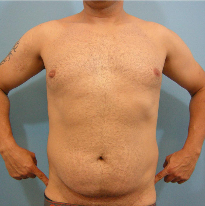 Liposhaping Sixpack