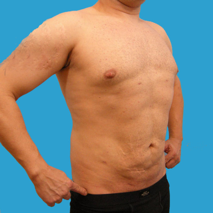 Liposhaping Sixpack