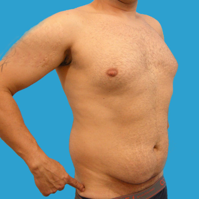 Liposhaping Sixpack