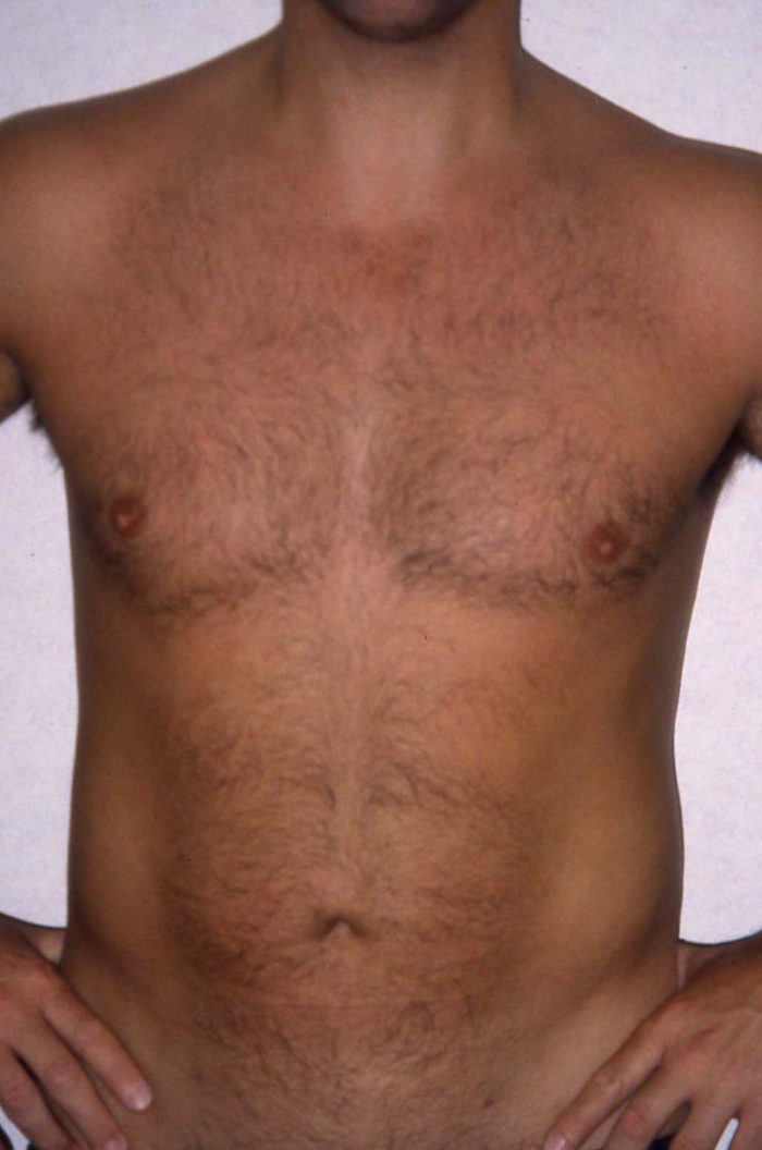 Liposhaping sixpack