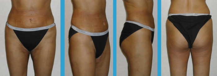 Liposhaping