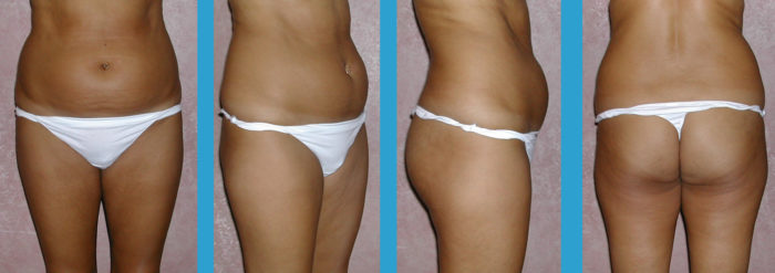 Liposhaping