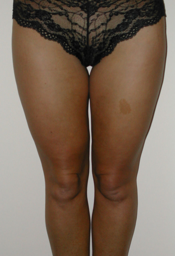 Knie und Oberschenkel vor Liposhaping
