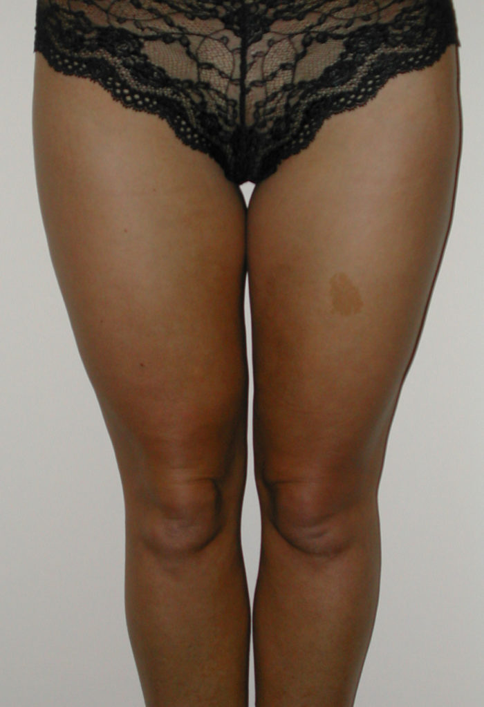 Knie und Oberschenkel vor Liposhaping
