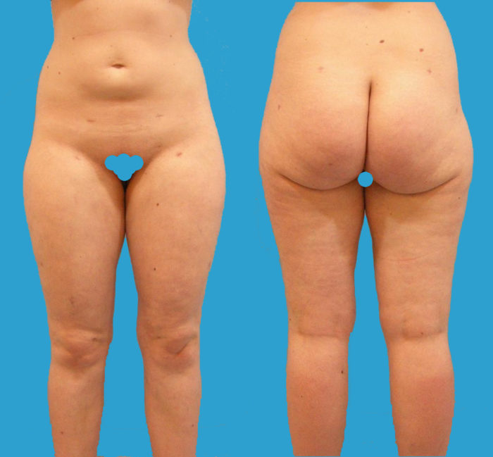 Liposhaping Reithose, Knie, Bauch