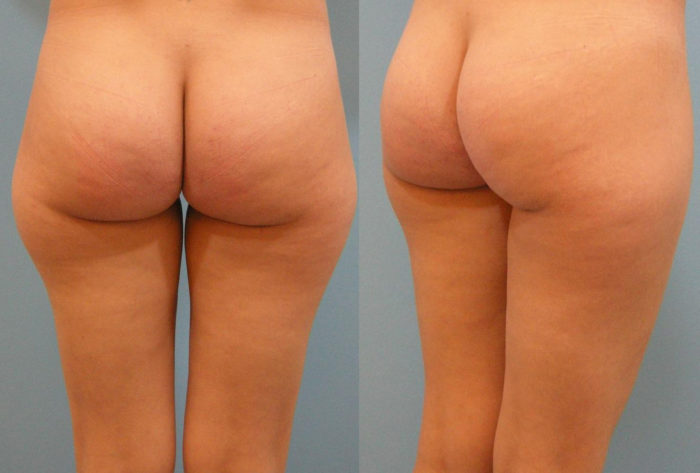 Liposuktion Reiterhose