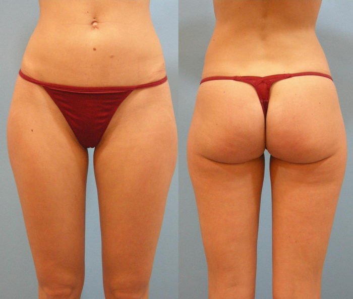 Liposculpting Oberschenkel