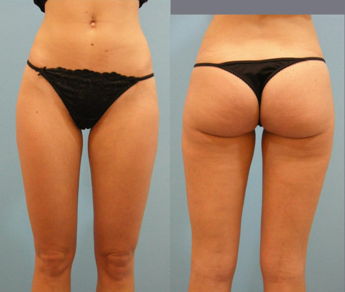 Liposculpting Oberschenkel