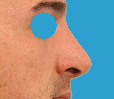 Rhinoplastik