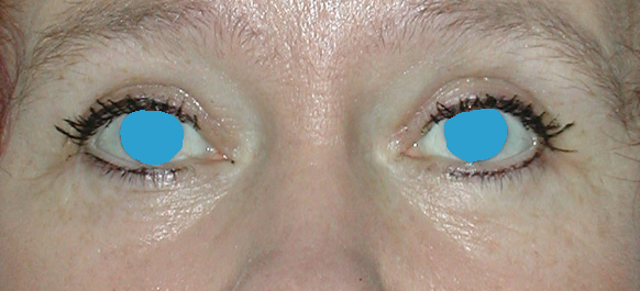 Augenlider nach Blepharoplastik