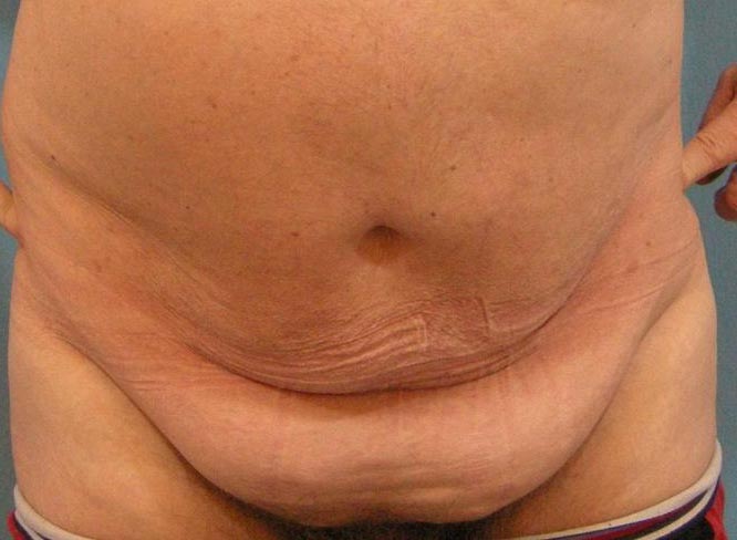 Liposuktion Schamhügel