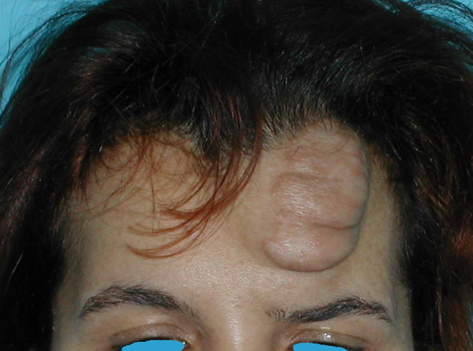 Tumor Stirnbereich