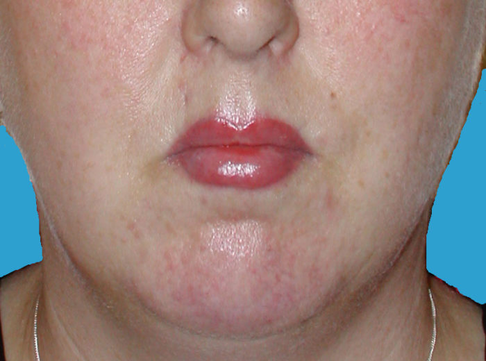 Lippenvergrößerung lip roll